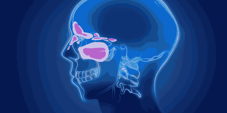 Causes of Sinusitis