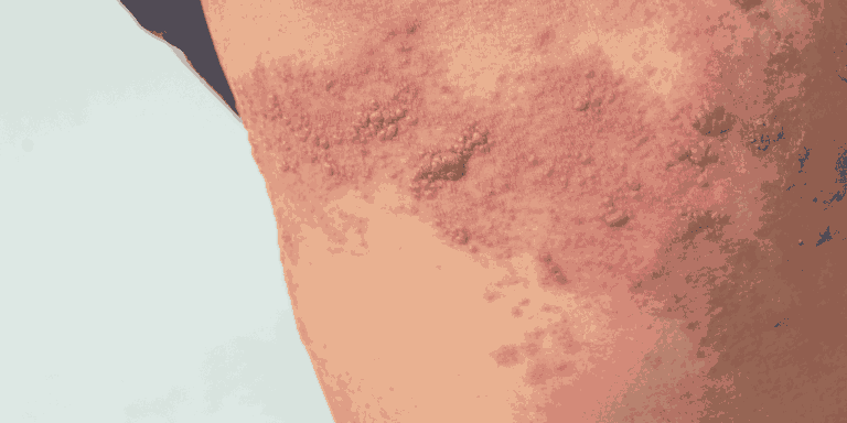 Shingles Contagious