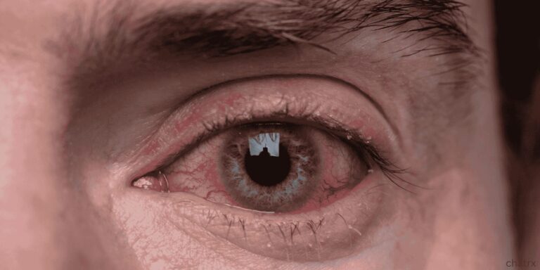 pink eye treatment