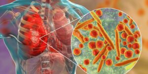 pneumonia