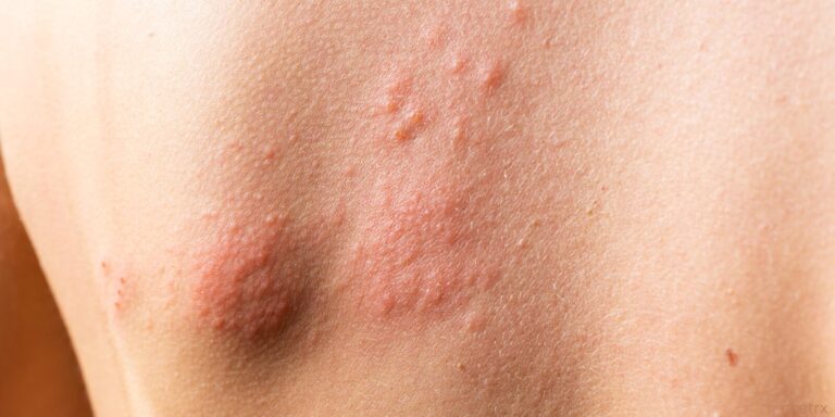 shingles