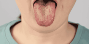 thrush infection