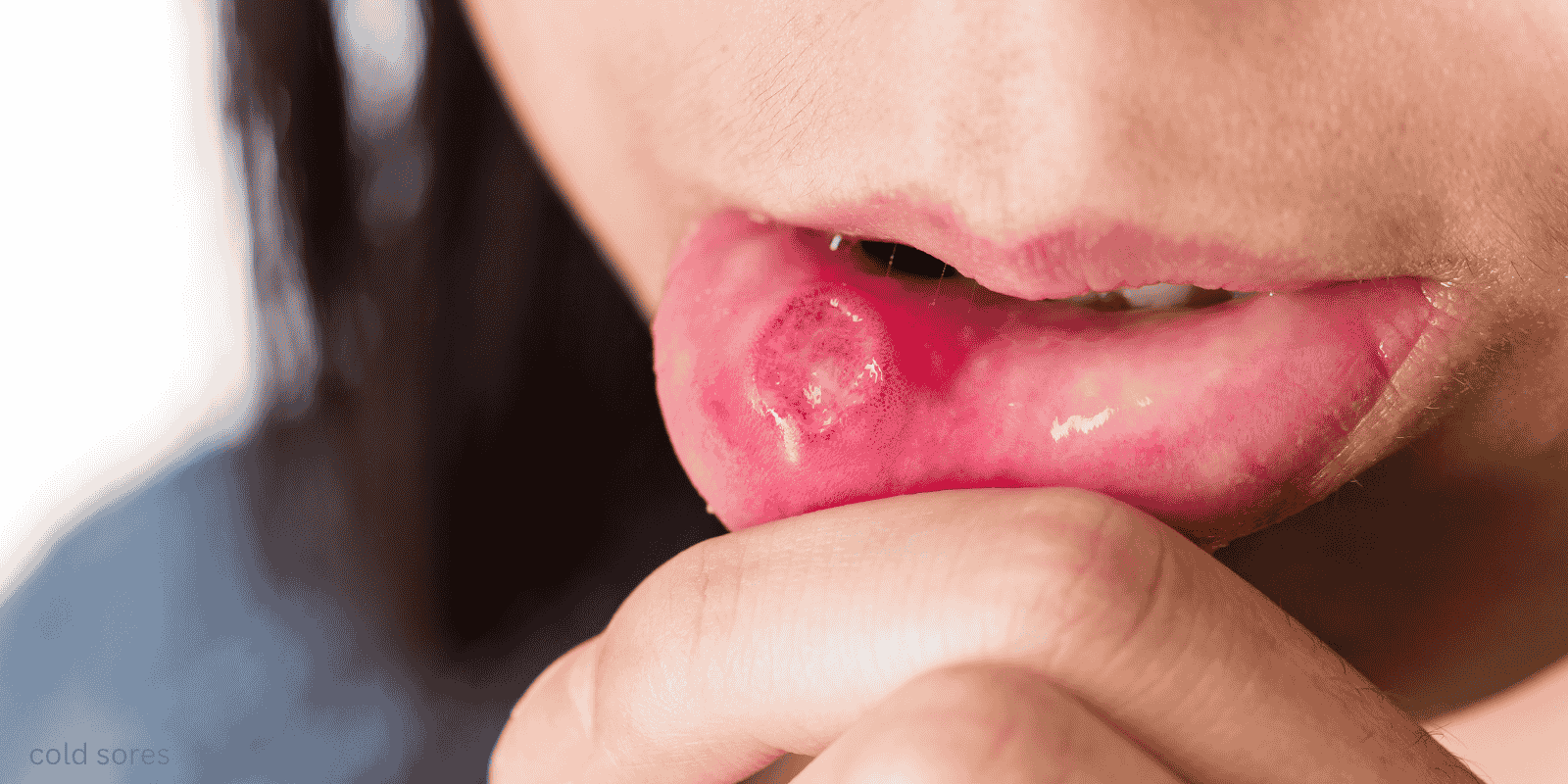 fever blisters