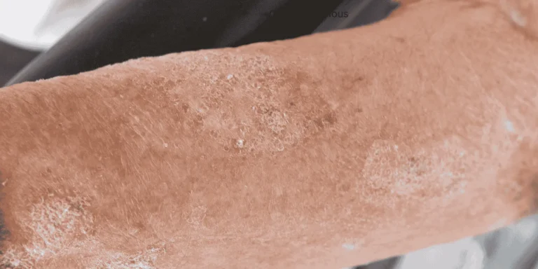 Cellulitis Serious