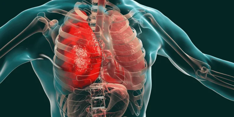 Pneumonia in Elderly Patients