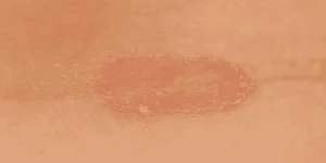 ringworm myths facts fungal infection misconceptions