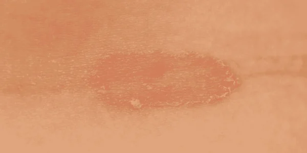 ringworm myths facts fungal infection misconceptions