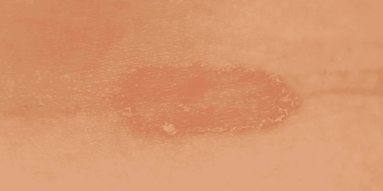 ringworm myths facts fungal infection misconceptions