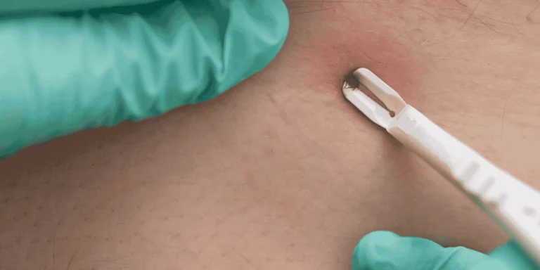 tick bite