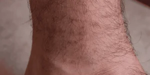 tick bite infection