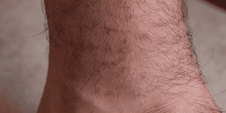 tick bite infection