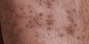 tick bite prophylaxis