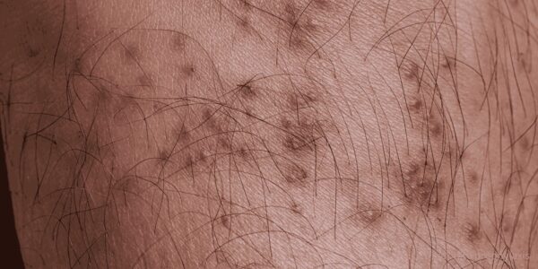 tick bite prophylaxis