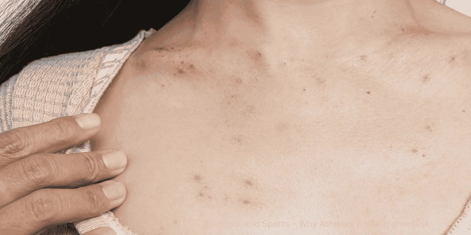 Jock Itch and Sports – Why Athletes Are at Higher Risk 