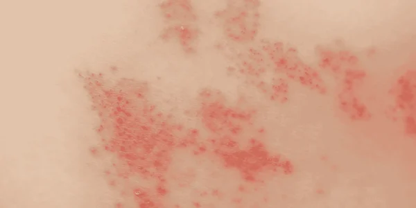 Shingles Rash