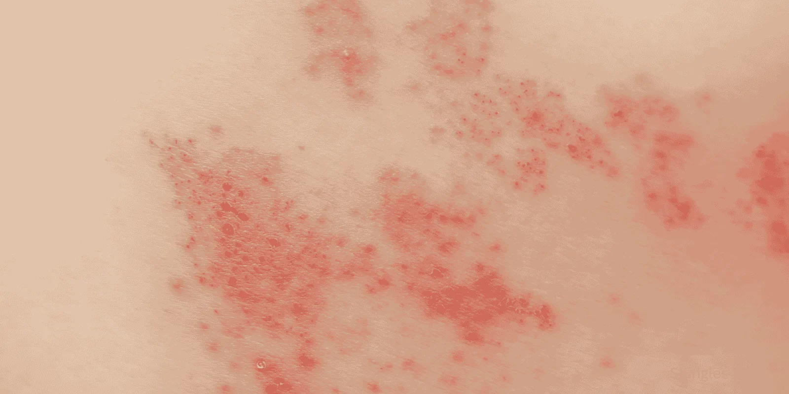Shingles Rash