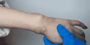 Tick Bite Swelling