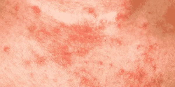 eczema bacterial infection scratching