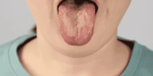 how long does thrush take to heal