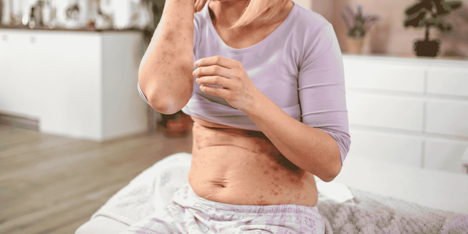 itchy skin allergy symptoms