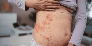measles rash vs spring rashes parents