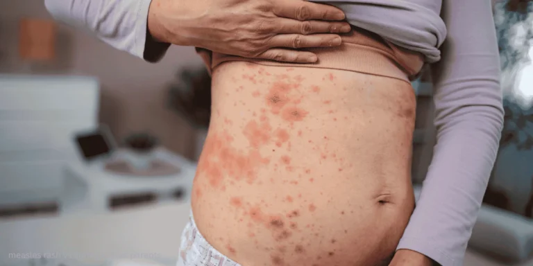 measles rash vs spring rashes parents