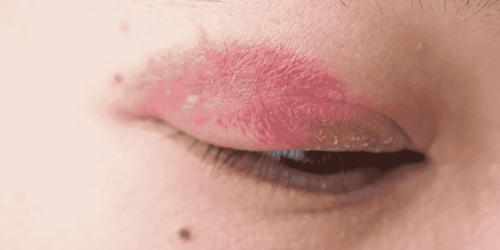 red itchy eyes with discharge what could be causing it