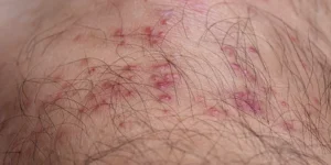 Tick Bite Symptoms