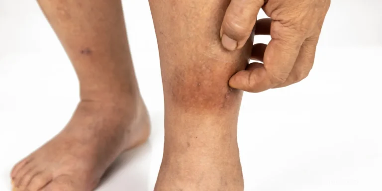 cellulitis treatment