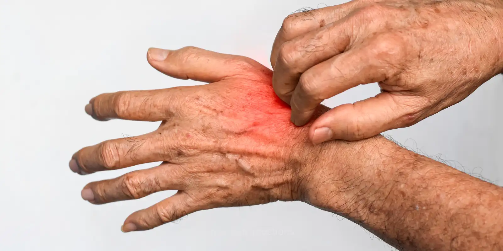 summer skin infections