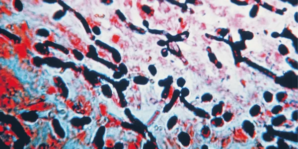 symptoms yeast infection bacterial vaginosis