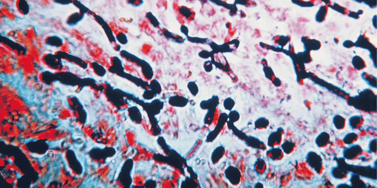 symptoms yeast infection bacterial vaginosis
